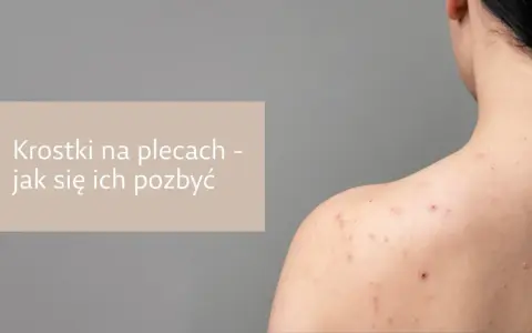 Pryszcze na plecach: Jak się ich pozbyć? Poradnik eksperta