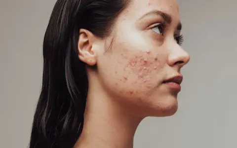 Reine Haut: Effektive Tipps gegen unreine Gesichtshaut & Pickel