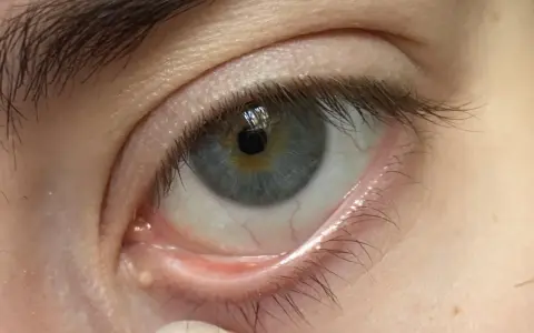 Ojo con milium en el contorno. Pequeños puntos blancos bajo la piel, un desafío para eliminar milium contorno ojos.