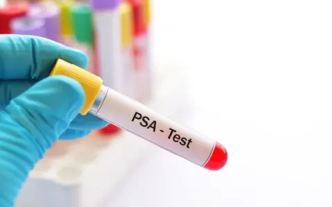 Ręka w niebieskiej rękawiczce trzyma probówkę z napisem "PSA - Test". Wynik badania psa 0.65 ng/ml.