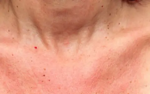 Peau rougie et irritée sur le cou et le décolleté, peut-être une réaction à une allergie au soleil. Combien de temps dure une allergie au soleil ?