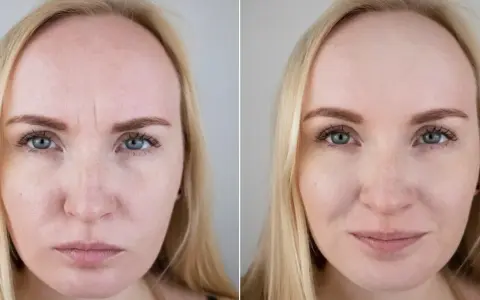 Przed i po zabiegu: mezoterapia mikroigłowa efekty widoczne na twarzy kobiety – wygładzone zmarszczki, poprawa tekstury skóry.