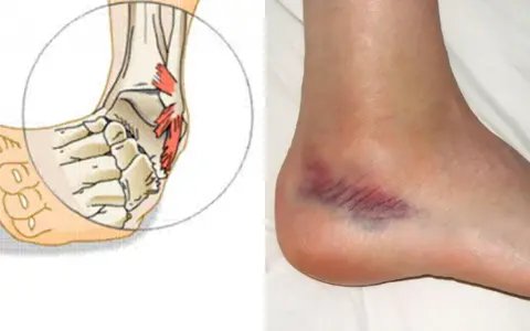 Illustrazione anatomica di una caviglia con legamenti danneggiati e foto di una caviglia con ematoma. Informazioni sui contusione caviglia tempi di recupero.