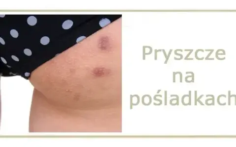 Jak szybko wysuszyć pryszcza? Skuteczne metody i czego unikać