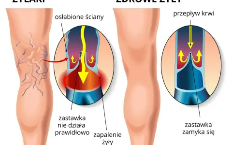 Porównanie żylaków i zdrowych żył. W żylakach zastawka nie działa, powodując zastój krwi. W zdrowych żyłach zastawka zamyka się prawidłowo.