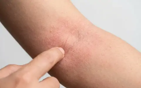 Rote, trockene Haut am Arm, die auf Neurodermitis hindeutet. Eine Hand berührt die betroffene Stelle, um zu zeigen, was hilft gegen Neurodermitis.