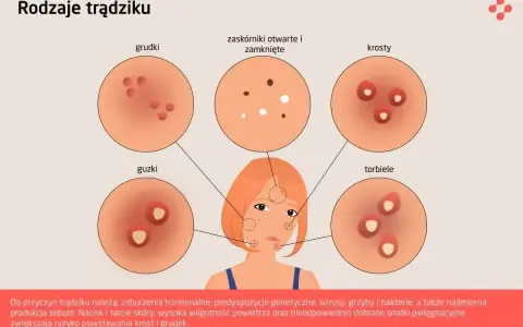 Ilustracja przedstawia różne rodzaje krost na twarzy: grudki, guzki, zaskórniki, krosty i torbiele.