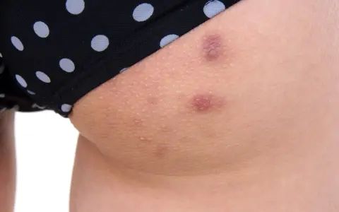 Zbliżenie na skórę pośladków z widocznymi krostkami i przebarwieniami, obok czarnej bielizny w białe kropki.