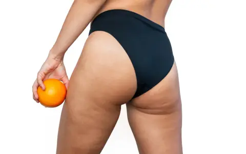 Mujer con naranja en mano, mostrando sus piernas y glúteos con celulitis. ¿Buscas como quitar celulitis piernas?