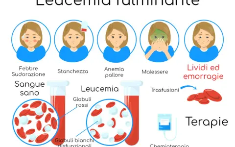 Leucemia fulminante: febbre, stanchezza, anemia, malessere, lividi. Globuli bianchi disfunzionali. Terapie: trasfusioni, chemioterapia.