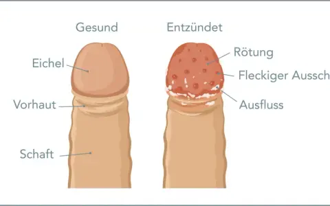 Vergleich von gesunder Eichel und entzündeter Eichel mit roten Punkten, Rötung, fleckigem Ausschlag und Ausfluss.