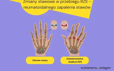 Porównanie zdrowych stawów dłoni z zaawansowanym stadium RZS, pokazujące zmiany zapalne. RZS pierwsze objawy mogą być subtelne.