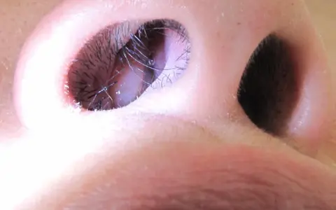 Primo piano delle narici, con peli visibili. Una speranza per chi soffre di polipi nasali: possono regredire.