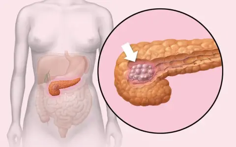 Ilustracja przedstawia trzustkę z guzem, wskazując na potencjalne przyczyny raka trzustki.