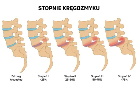 Ilustracja pokazuje stopnie kręgozmyku od zdrowego kręgosłupa do zaawansowanych stadiów, gdzie kręgi przesuwają się względem siebie.
