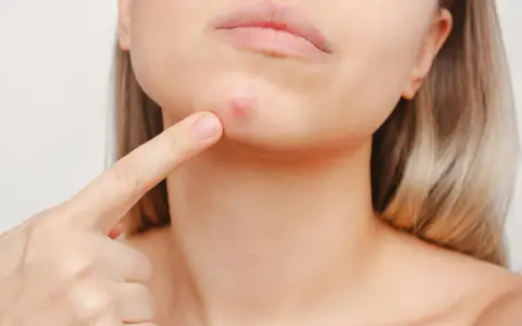Ein Finger zeigt auf einen roten Pickel am Kinn. Vielleicht hilft eine Zugsalbe, diesen lästigen Pickel schnell verschwinden zu lassen.