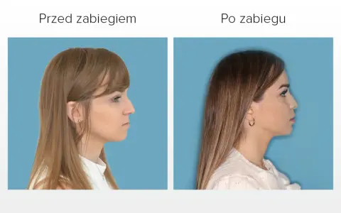 Przed i po zabiegu: poprawa wyglądu twarzy dzięki korekcie wady zgryzu.