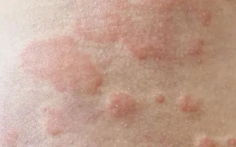 Czerwone, swędzące bąble na skórze. Czy pokrzywka jest zaraźliwa? Nie, to reakcja alergiczna, nie przenosi się przez kontakt.