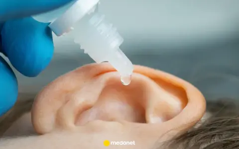 Kropla leku spada do ucha, które jest leczone.