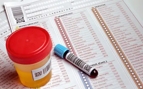 Pojemnik z próbką moczu i probówka leżą na formularzu analiz laboratoryjnych. Może to być związane z badaniem czerwonego moczu u dziecka.