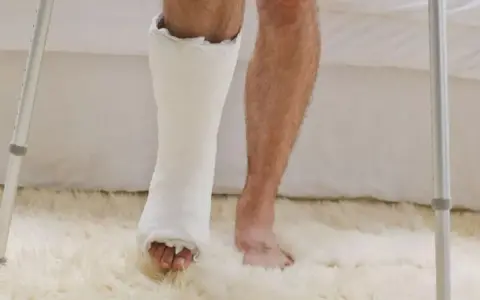 Noga w gipsie i zdrowa noga obok, przygotowanie do rehabilitacji po zdjęciu gipsu.