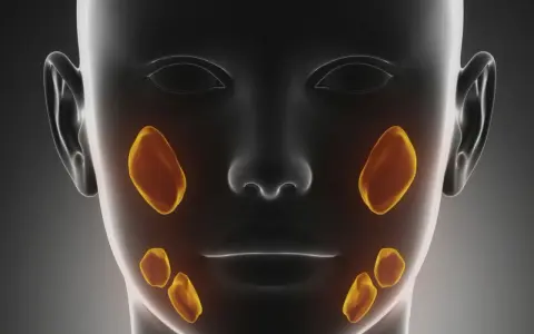 Anatomia ślinianek z zaznaczonymi kamieniami. Domowe sposoby na kamień w śliniance mogą pomóc złagodzić objawy.