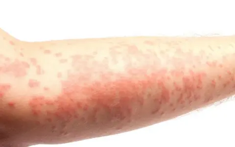 Alergia na sierść: objawy skórne, które mogą zaskoczyć każdego