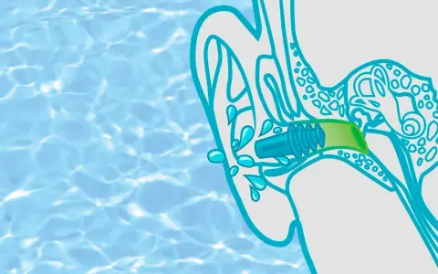 Illustration zeigt ein Kind, das Wasser im Ohr hat. Ein Stöpsel schützt das Ohr vor weiterer Flüssigkeit.