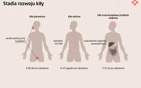 Ilustracja przedstawia stadia rozwoju kiły: pierwotna (wrzód), wtórna (wysypka skórna) i trzeciorzędowa (uszkodzenia narządów).