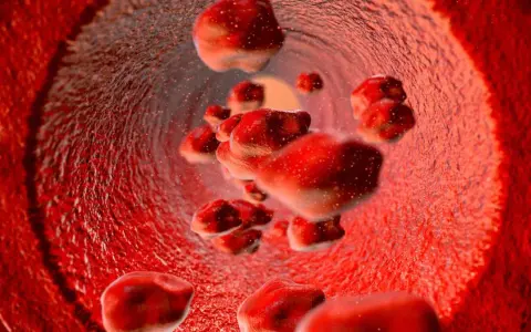 Czerwienica prawdziwa to choroba mieloproliferacyjna, nie nowotwór złośliwy. Widok naczyń krwionośnych z nadmiarem czerwonych krwinek.