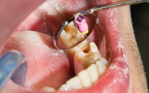 Dentysta podczas leczenia kanałowego zęba. W odbiciu lusterka widać narzędzie stomatologiczne i różowy kołeczek z oznaczeniem rozmiaru.