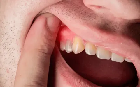 Zapalenie dziąseł? Skuteczne płukanki i kiedy do dentysty