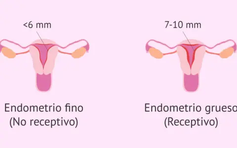 Ilustración comparativa de úteros. Uno muestra un endometrio fino (<6 mm, no receptivo), el otro un endometrio grueso (7-10 mm, receptivo).