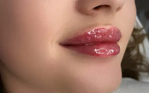 Błyszczące, pełne usta z efektem baby doll lips, podkreślone błyszczykiem.