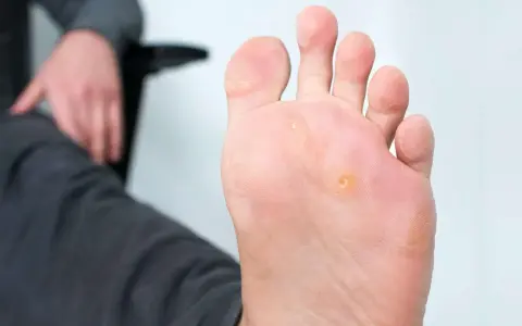 Un pied présente des cors, notamment un cors au pied bien visible sous la plante. La personne semble s'apprêter à soigner cette affection.