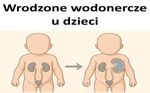 Ilustracja pokazuje rozwój zastoju nerki 2 stopnia u dziecka. Zdrowa nerka po lewej, po prawej powiększona, z widocznym zastojem.
