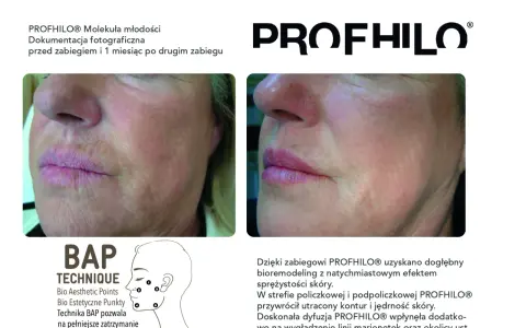 Przed i po zabiegu Profhilo. Skóra wygładzona, bez widocznych efektów ubocznych.