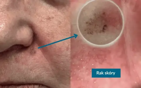 Niepokojący pieprzyk na nosie, powiększony dermatoskopem, ujawnia zmiany sugerujące raka skóry.