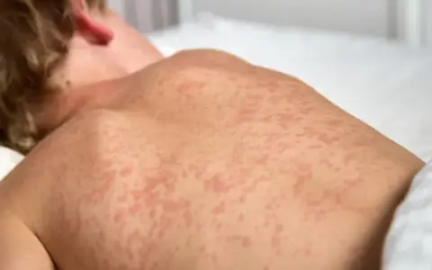 Sarpullido por medicamento: ¿Alergia? Síntomas y cuándo ir a urgencias.