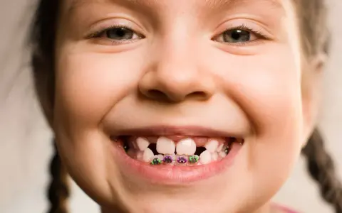 Ruchomy aparat ortodontyczny dla dziecka: wygląd, budowa i personalizacja