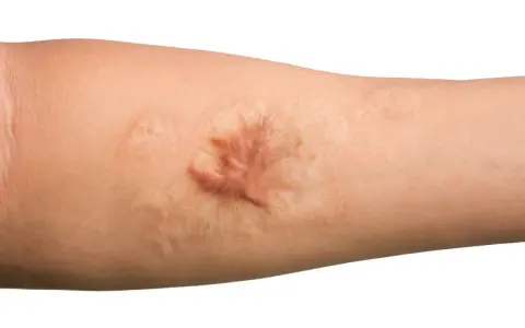 Gros plan sur un bras humain montrant une cicatrice hypertrophique, surélevée et rosée, témoignant d'une guérison cutanée complexe.