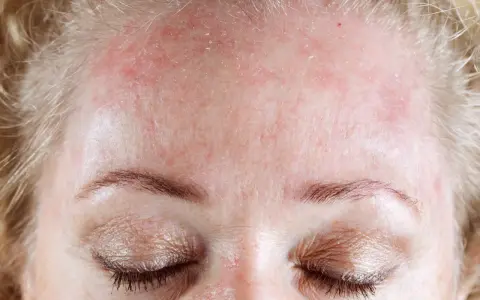 Fronte arrossata e desquamata, un segno di dermatite seborroica. Speriamo in un miracolo dermatite seborroica per ritrovare una pelle sana.