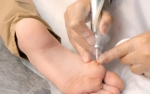 Traitement d'une verrue plantaire au laser par un podologue. Le tarif pour cette intervention est abordable.