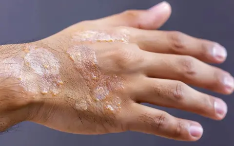 Main d'une personne atteinte de psoriasis, montrant des plaques rouges et squameuses. Une solution à base d'huile essentielle pourrait aider à soulager ces symptômes.