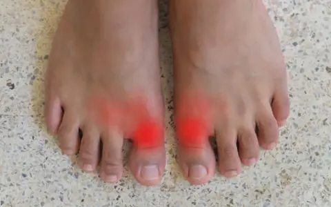 Två fötter med röda områden vid stortålederna, som indikerar smärta. Många delar sina hallux rigidus erfarenheter online.