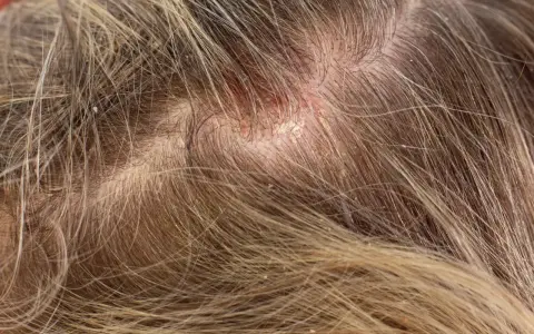 Nahaufnahme der Kopfhaut mit Haaren, die einen roten, schuppigen schorf am hinterkopf zeigen.
