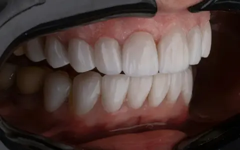Piękne, zdrowe zęby po leczeniu periodontologicznym. Uśmiech pełen blasku i pewności siebie.