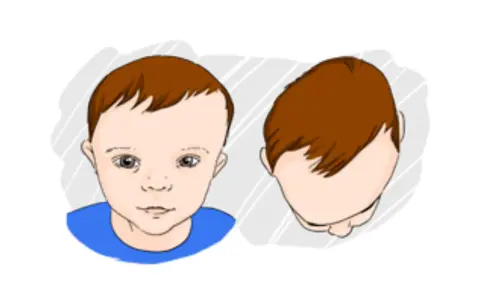 Ilustracja pokazuje niemowlaka z asymetrią główki, co może wskazywać na plagiocefalię.