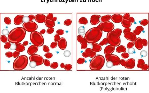 Vergleich von roten Blutkörperchen: Links normal, rechts erhöht (erythrozyten zu hoch). Polyglobulie durch Sauerstoffmangel.