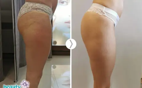 Endermologia: Hit czy Kit? Obiektywna Analiza Efektów i Kosztów
